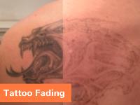 The Tattoo Removal Experts image 10